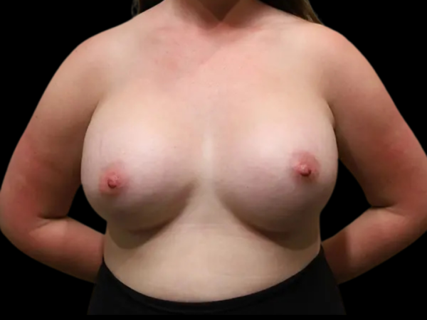 Breast Exchange Patient 59 After 1