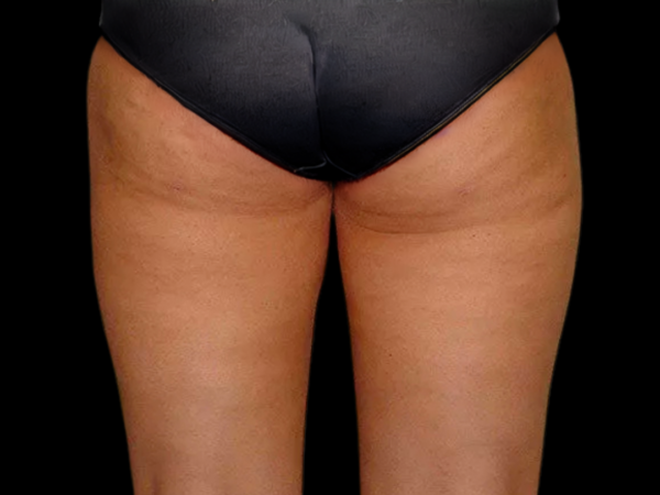 Liposuction Patient 03 After 2