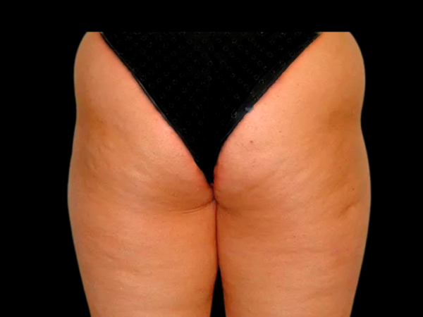 Liposuction Patient 03 Before 2