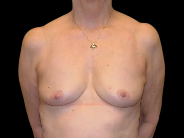 Breast Reconstruction Patient 03 Before 1