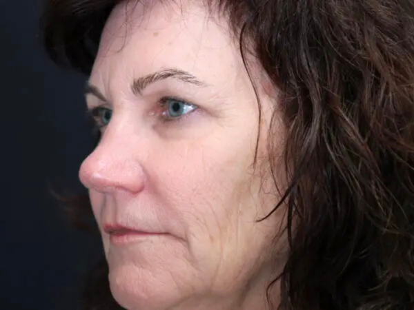 Eyelid Surgery Patient 24 Before 1