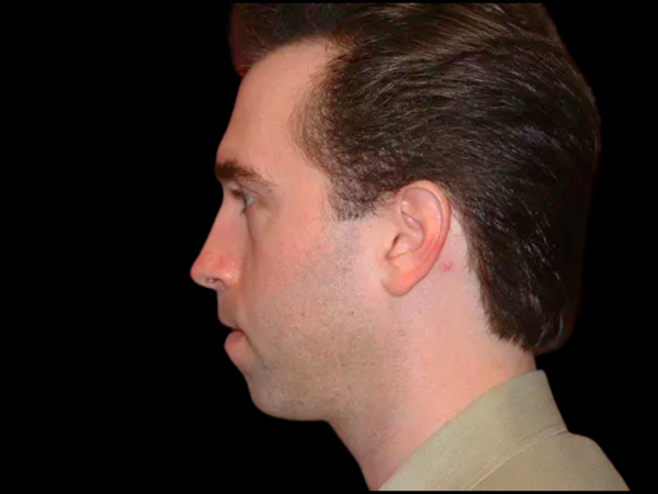 Chin Augmentation Patient 05 Before 2