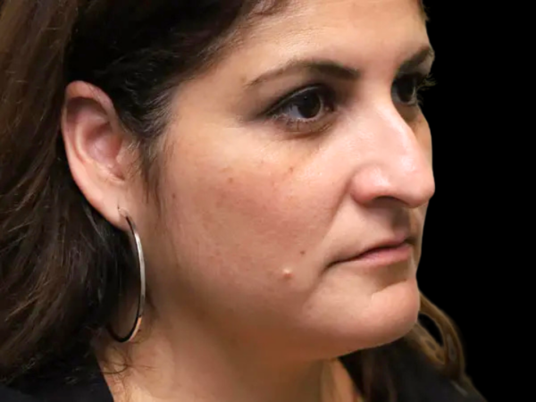 Rhinoplasty Patient 50 Before 1