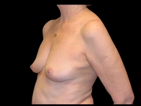 Breast Reconstruction Patient 03 Before 2