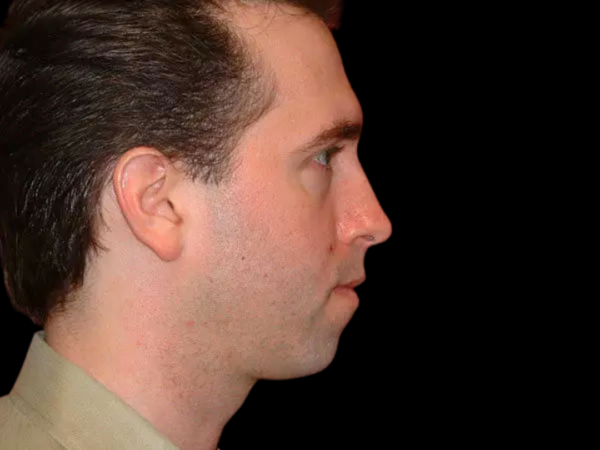 Chin Augmentation Patient 05 Before 1