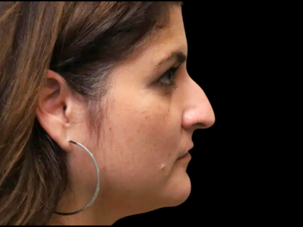 Rhinoplasty Patient 50 Before 2