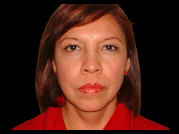 Brow Lift Patient 03 Before 1