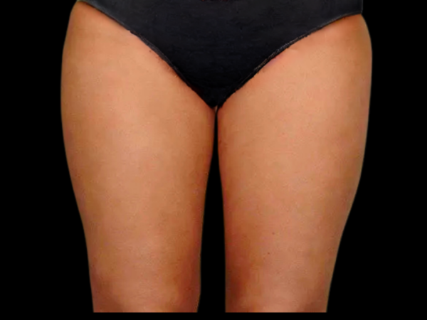 Liposuction Patient 03 After 1