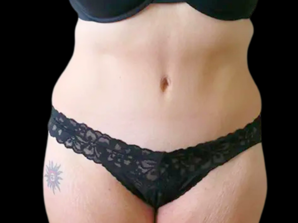 Tummy Tuck with Lipo Patient 1 After 1