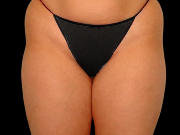 Liposuction Patient 03 Before 1