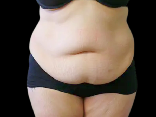 Tummy Tuck with Lipo Patient 1 Before 1