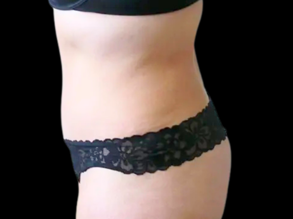 Tummy Tuck with Lipo Patient 1 After 2