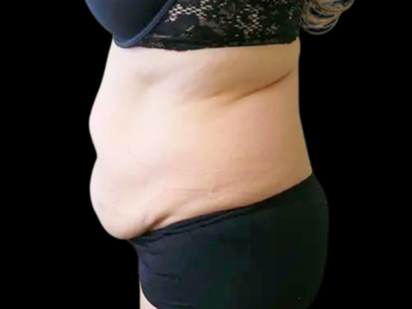 Tummy Tuck with Lipo Patient 1 Before 2