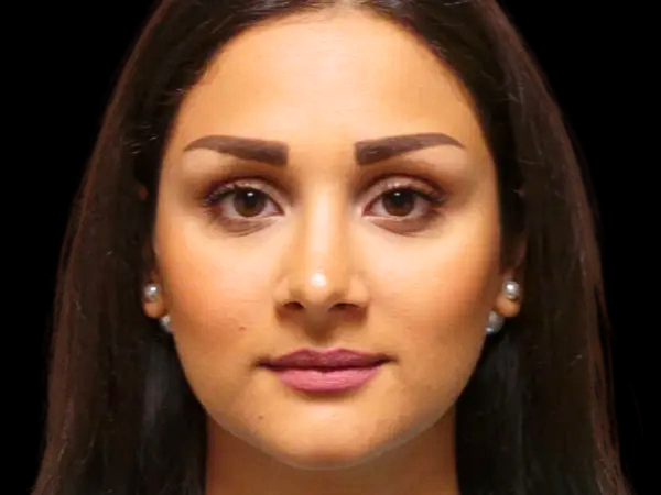 Rhinoplasty Patient 29 After 1