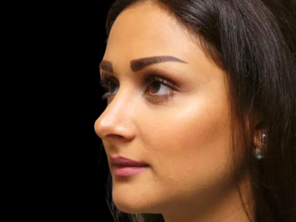 Rhinoplasty Patient 29 After 2
