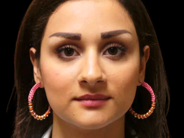 Rhinoplasty Patient 29 Before 1
