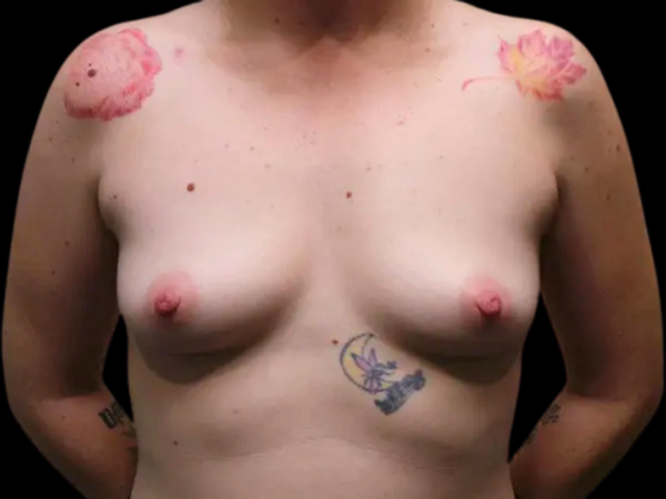 Breast Augmentation Patient 18 Before 1