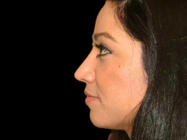 Rhinoplasty Patient 06 After 1
