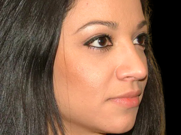 Rhinoplasty Patient 06 After 2