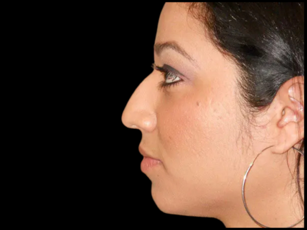 Rhinoplasty Patient 06 Before 1