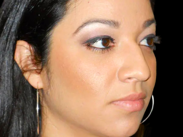Rhinoplasty Patient 06 Before 2