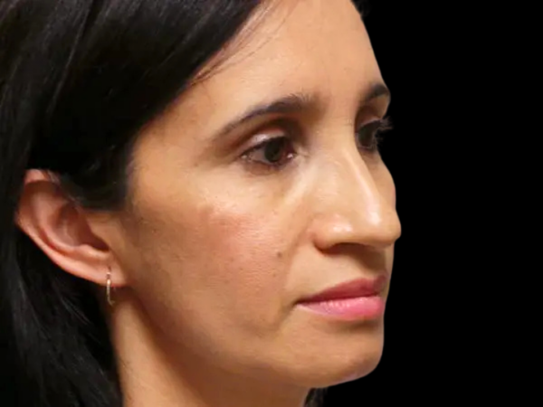 Rhinoplasty Patient 13 Before 2