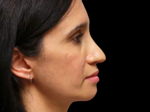 Rhinoplasty Patient 13 Before 1