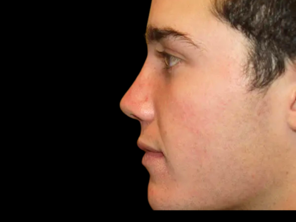Rhinoplasty Patient 04 After 1