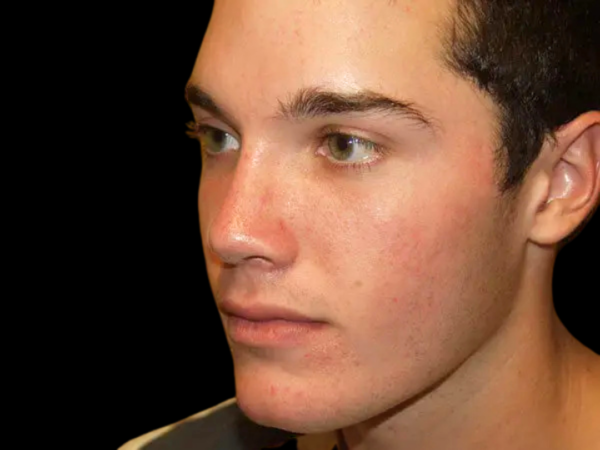Rhinoplasty Patient 04 After 2