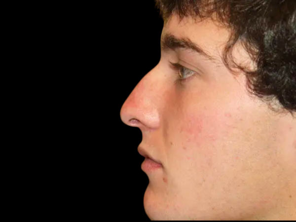 Rhinoplasty Patient 04 Before 1