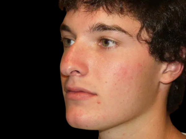 Rhinoplasty Patient 04 Before 2