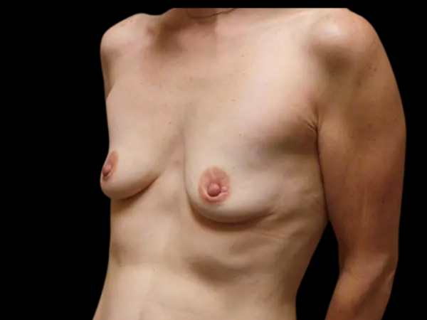 Breast Augmentation Patient 21 Before 2