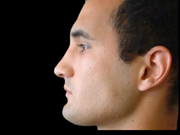 Rhinoplasty Patient 03 After 1