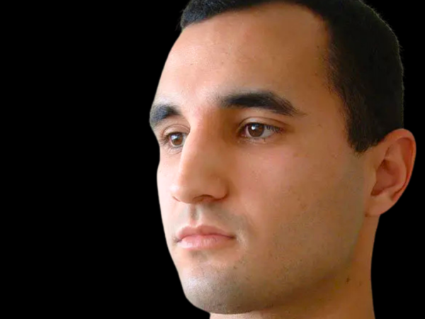 Rhinoplasty Patient 03 After 2