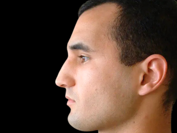 Rhinoplasty Patient 03 Before 1