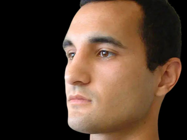 Rhinoplasty Patient 03 Before 2