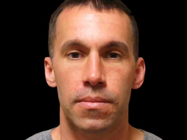Rhinoplasty Patient 02 After 1