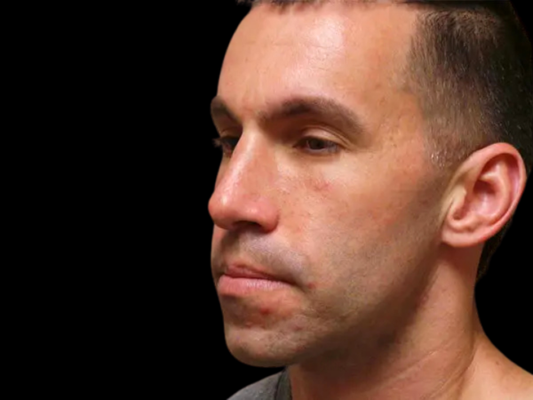 Rhinoplasty Patient 02 After 2