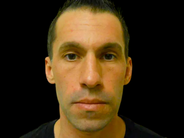 Rhinoplasty Patient 02 Before 1