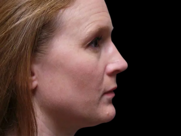 Rhinoplasty Patient 11 After 1