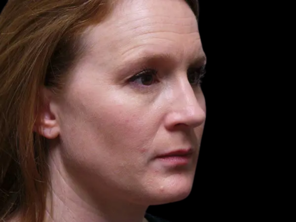 Rhinoplasty Patient 11 After 2