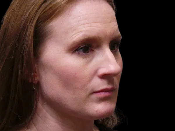 Rhinoplasty Patient 11 Before 2