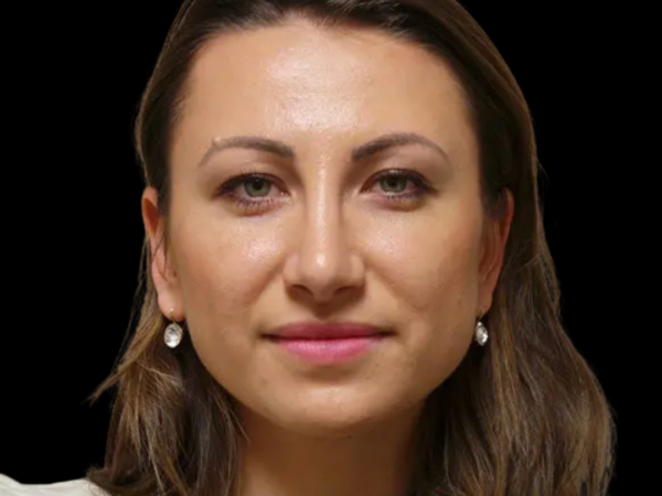 Rhinoplasty Patient 01 After 1