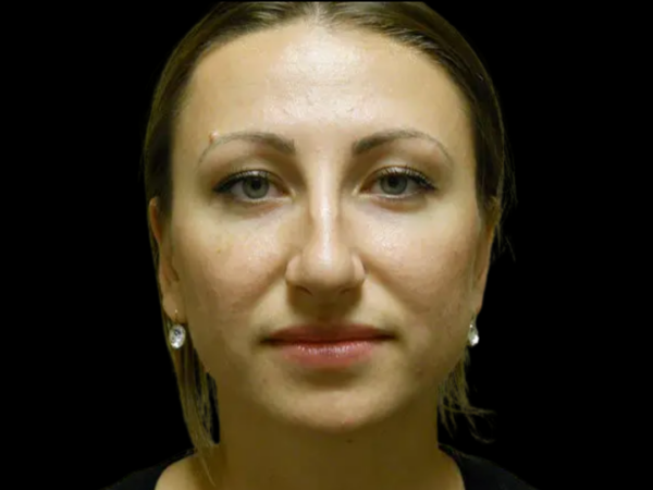 Rhinoplasty Patient 01 Before 1