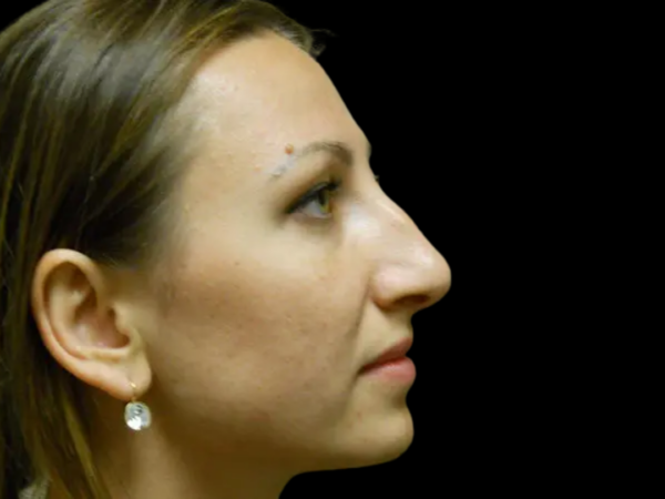 Rhinoplasty Patient 01 Before 2