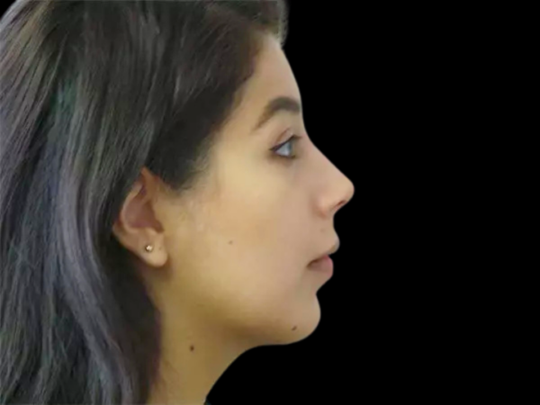 Chin Augmentation Patient 02 After 1