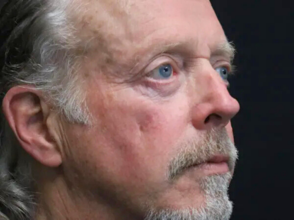 Eyelid Surgery Patient 25 After 1