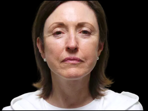 Facelift Patient 03 After 1