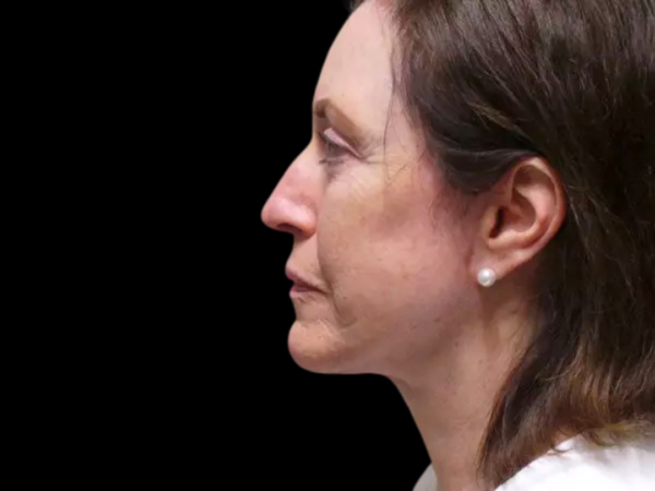 Facelift Patient 03 After 2