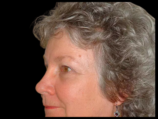 Brow Lift Patient 04 After 2